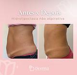 Hidrolipoclasia não aspirativa (APLICAÇÃO)