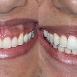 Botox Sorriso Gengival