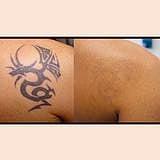 Aesthetic - Remoção Tatuagem (preto e colorido)