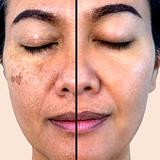 Aesthetic - Melasma