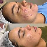 Acne Solution - Tratamento de acne