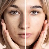 Aesthetic - Acne Ativa (inflamatória)