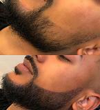 Pigmentação de Barba