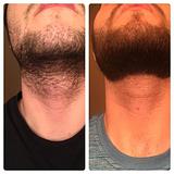 Pigmentação de barba 
