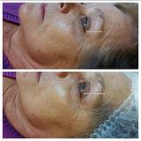 Limpeza de Pele Hidra C