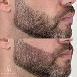 Preenchimento de Barba