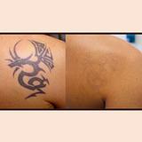 Aesthetic - Remoção tatuagem (preto e colorido)