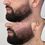 Nanopigmentação  de Barba