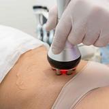 Radiofrequência corporal 1 região 