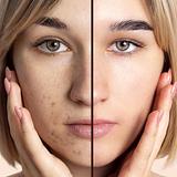 Aesthetic - Acne Ativa (inflamatória)