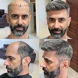 Manutenção de Prótese Capilar   