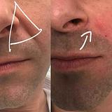 Preenchimento fossa canina