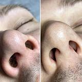 Depilação de Nariz