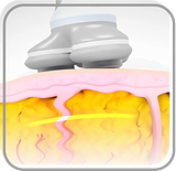 Ultralipólise  - Lipo sem corte